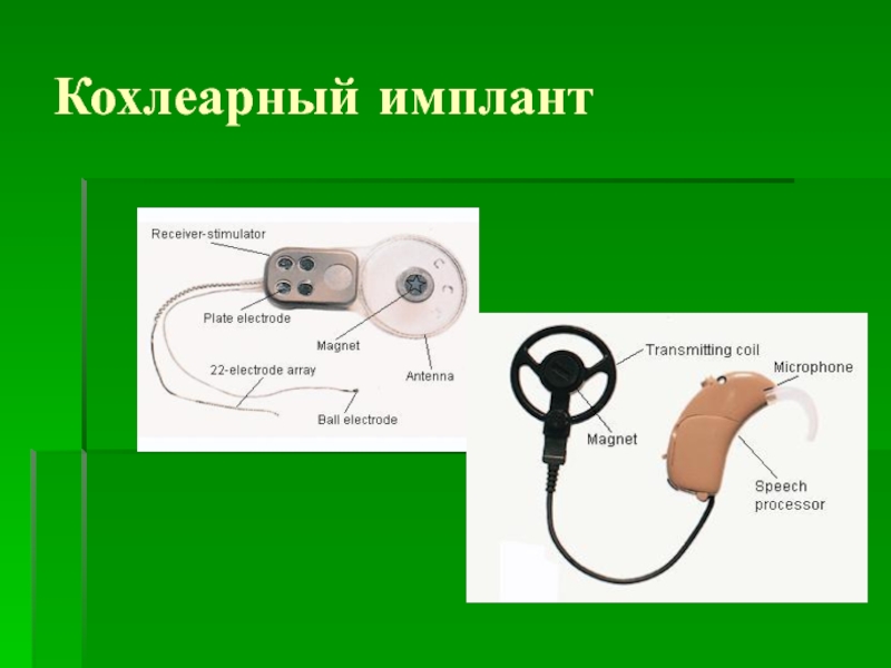 Схема работы кохлеарного импланта