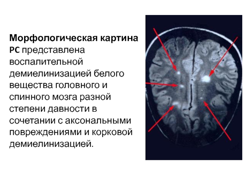 Изменения белого вещества головного мозга сосудистого. Демиелинизация спинного мозга. Заключение мрт головного мозга при рассеянном склерозе. Очаги рассеянного склероза на мрт. Очаги в спинном мозге при рассеянном склерозе.
