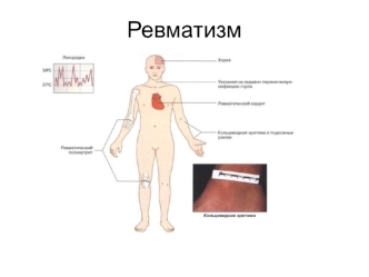 Острая ревматическая лихорадка