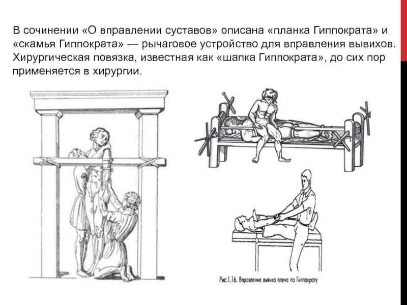 Гиппократ хирургия. Вправление вывиха метод Гиппократа. Вправление вывиха плеча по Гиппократу. Скамья Гиппократа фото.