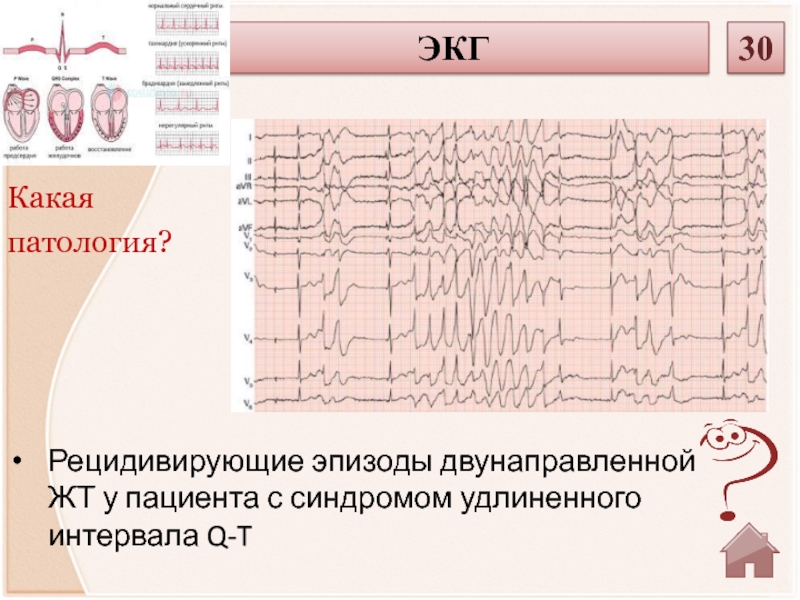 Патологии экг презентация