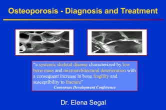 Osteoporosis - Diagnosis and Treatment