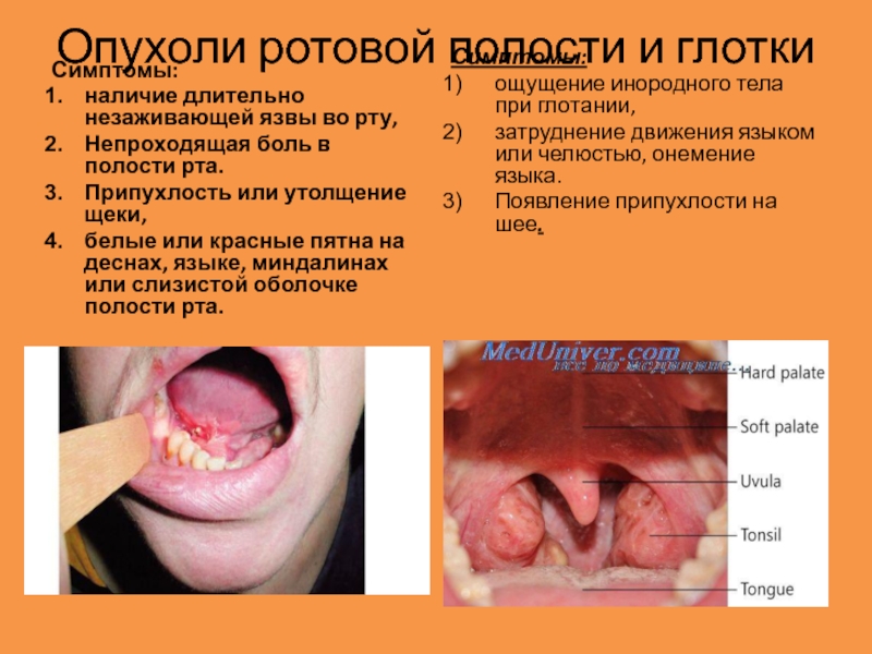 Опухоль на языке сбоку фото