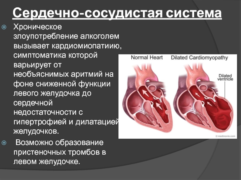Дилатация правых отделов. Аритмия сердца. Дилатация левого желудочка. Недостаточность левого желудочка сердца. Дилатация желудочков сердца.