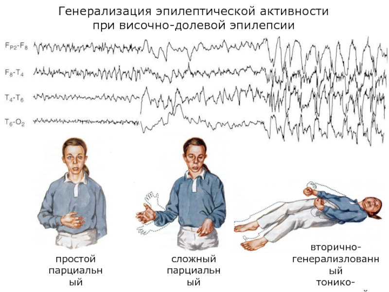 Парциальные судороги карта вызова