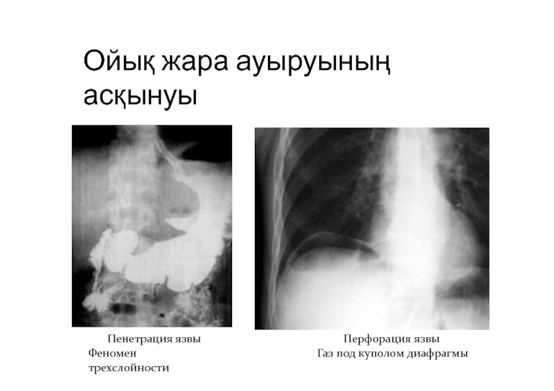 Прикрытая перфорация язвы