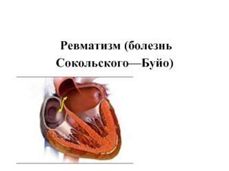 Ревматизм (болезнь Сокольского-Буйо)