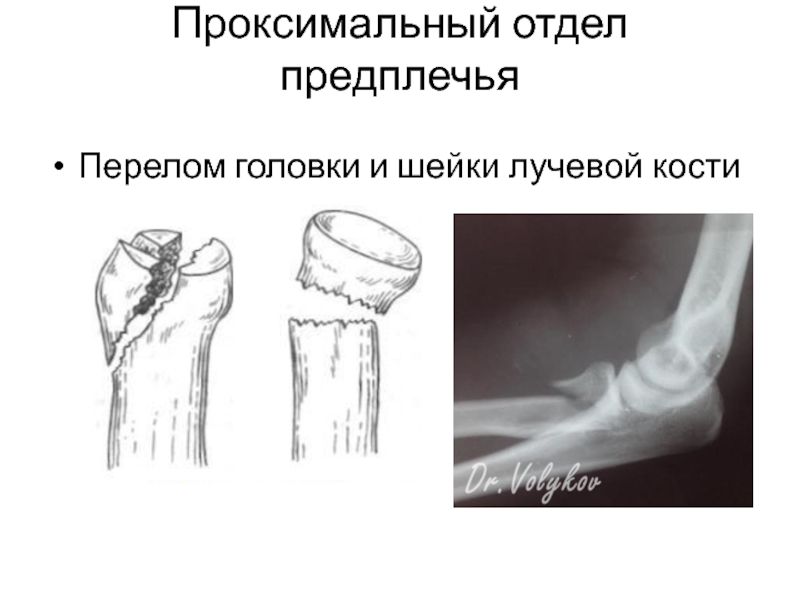 Перелом головки предплечья