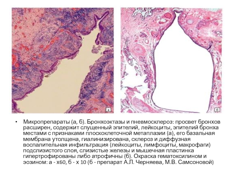 Бронхоэктазы патологическая анатомия. Слущенный эпителий бронхов. Пневмосклероз микропрепарат.