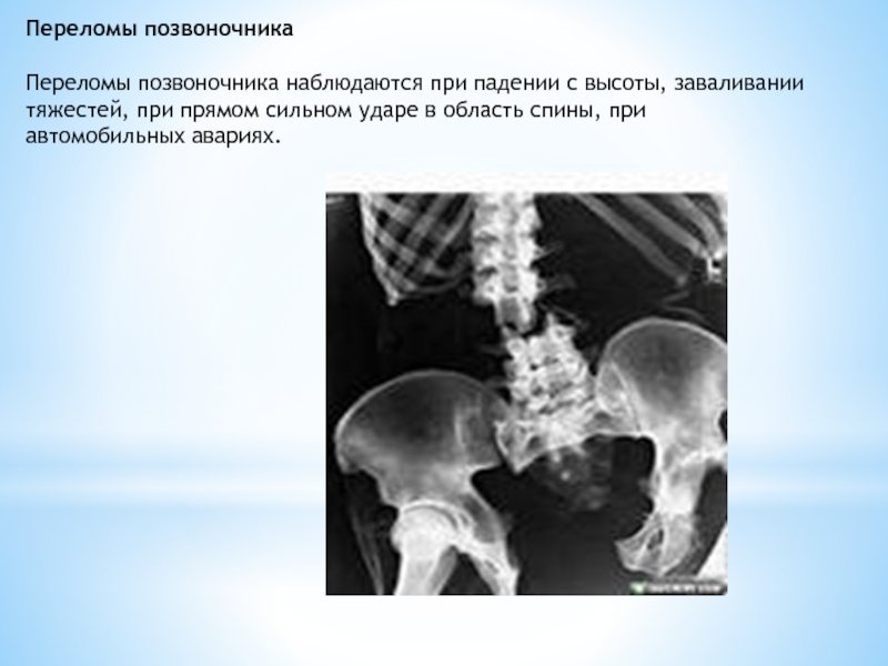 Травмы при падении с высоты презентация