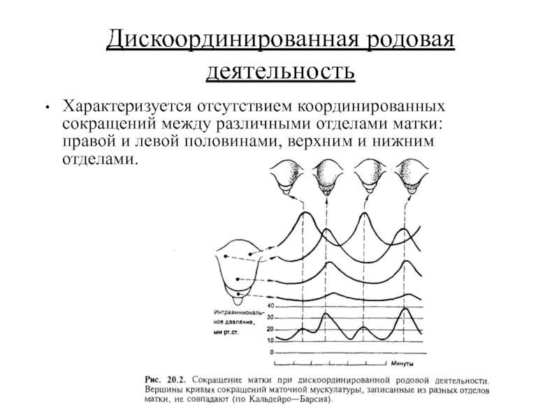 Аномалии родовой деятельности картинки