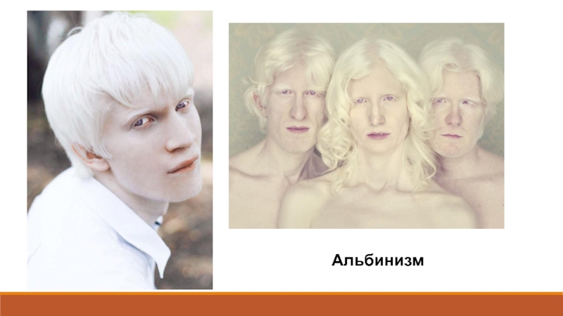 Альбинизмом страдают. Генетические заболевания альбинизм. Альбинизм наследственное заболевание. Частичный альбинизм у человека.