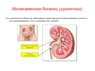 Мочекаменная болезнь (уролитиаз)