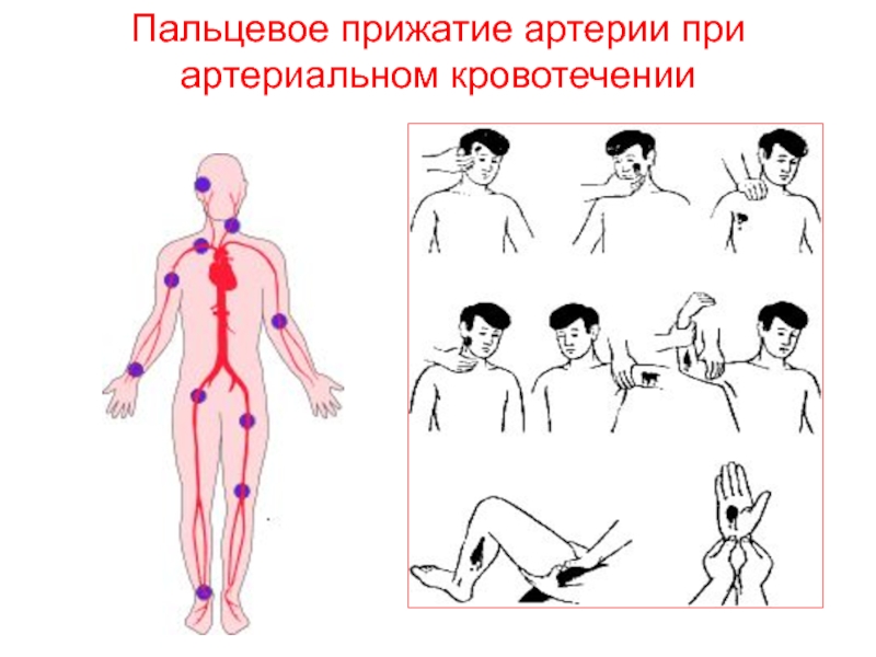 Рисунок названием артерий и костей к которым осуществляется прижатие артерии при кровотечении