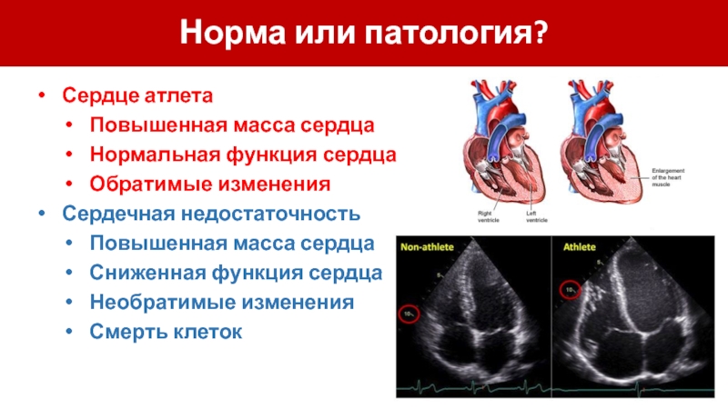 Сердце бывает. Сердце спортсмена и обычного человека. Сердце спортсмена и сердце обычного человека. Физиологическое и патологическое спортивное сердце. Сердце бегуна и обычного человека.