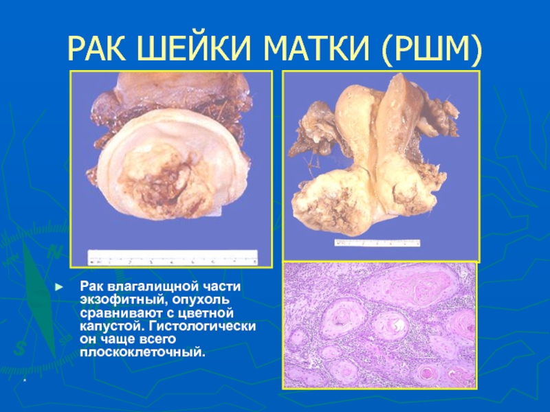 Миоматозный узел рождающийся фото