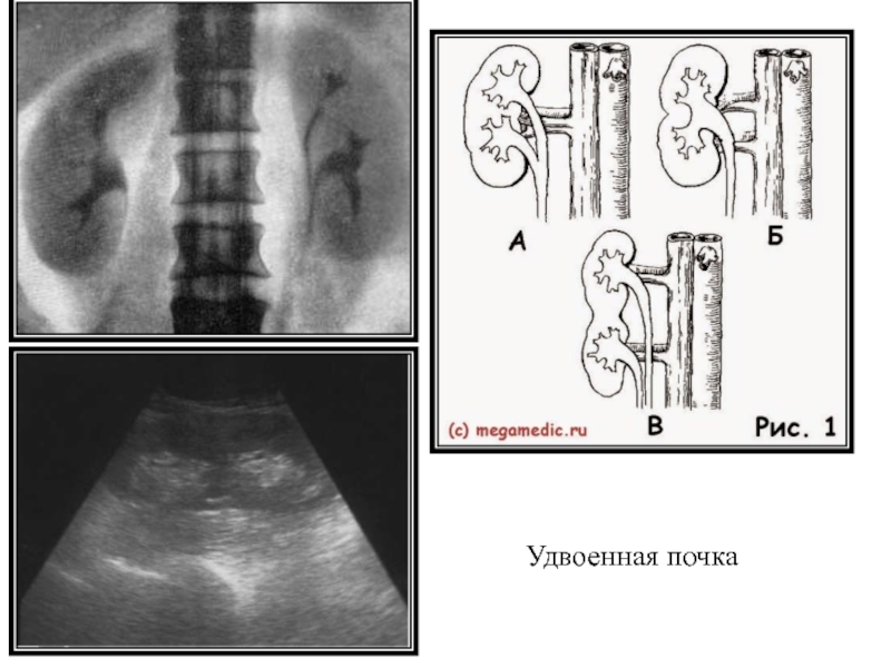 Фото удвоенной почки