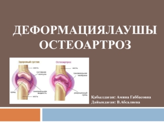 Деформациялауші остеоартроз