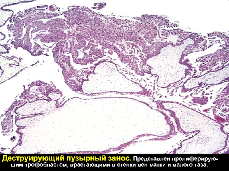 Пузырный занос форум. Пузырный занос гистология. Полный пузырный занос гистология. Деструирующий пузырный занос гистология. Частичный пузырный занос гистология.