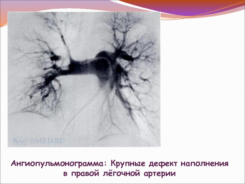 Тромбоэмболия легочной артерии мкб. Пульмональная артерия. Тромбоэмболия легочной артерии микропрепарат. Дефект наполнения сосудов.