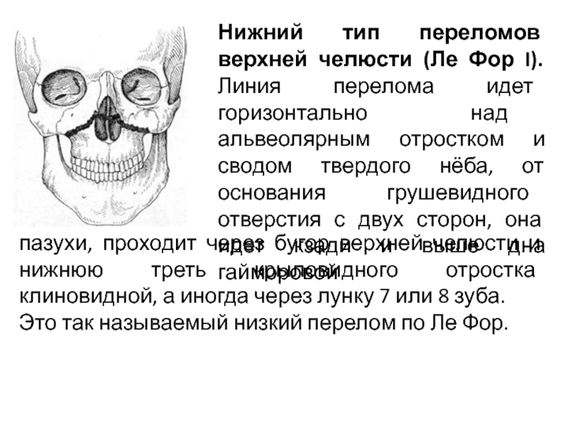 Перелом верхней челюсти тесты с ответами. Переломы верхней челюсти реферат. Переломы верхней челюсти по Лефор. Перелом верхней челюсти Ле фор 1. Переломы нижней челюсти реферат.