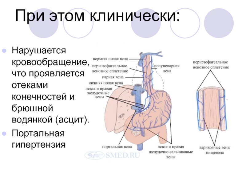 Портальная гипертензия мкб