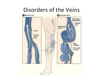 Disorders of the Veins