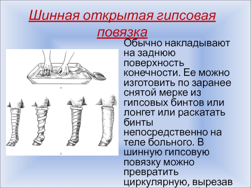 Применение гипсовой повязки ученый. Шинная открытая гипсовая повязка. Шарнирная гипсовая повязка. Гипсовая повязка накладывается на конечность. Классификация гипсовых повязок.