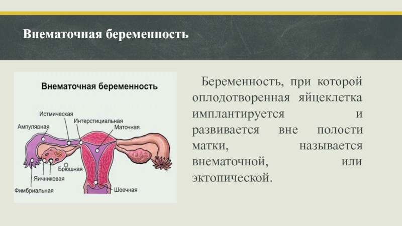 Эктопическая беременность презентация