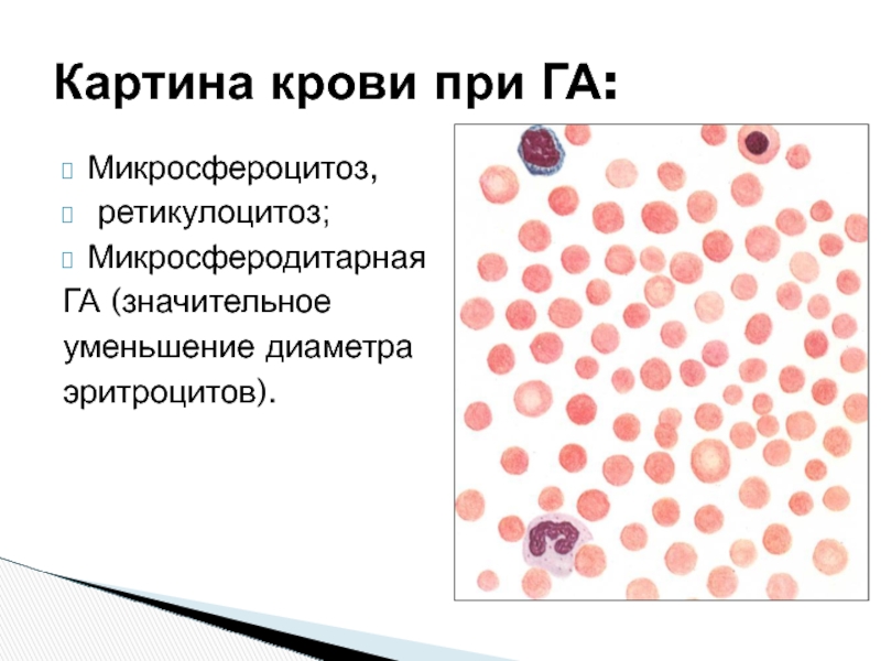 Гемолитическая анемия картина крови. Картина крови при наследственной гемолитической анемии. Наследственный сфероцитоз (болезнь Минковского-Шоффара). Строение эозинофильных лейкоцитов.