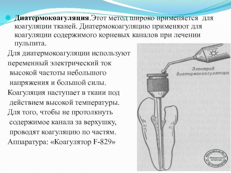 Метод широко. Диатермокоагуляция. Метод диатермокоагуляции. Диатермокоагуляция корневого канала. Диатермокоагуляция методика.