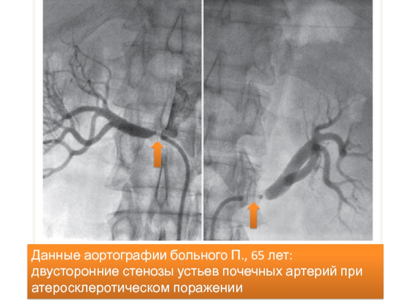 Устье почки. Двусторонний стеноз почечных артерий. Стеноз почечной артерии. Устье почечной артерии. При двустороннем стенозе почечных артерий противопоказаны.