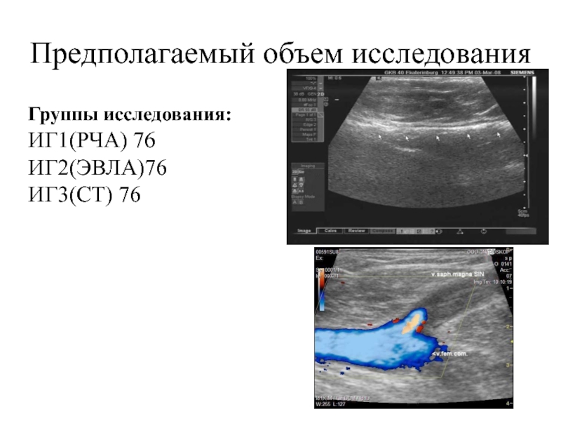 Предполагаемый объем. Показатели эффективности РЧА. Рекомендации после ЭВЛ нижних коне.