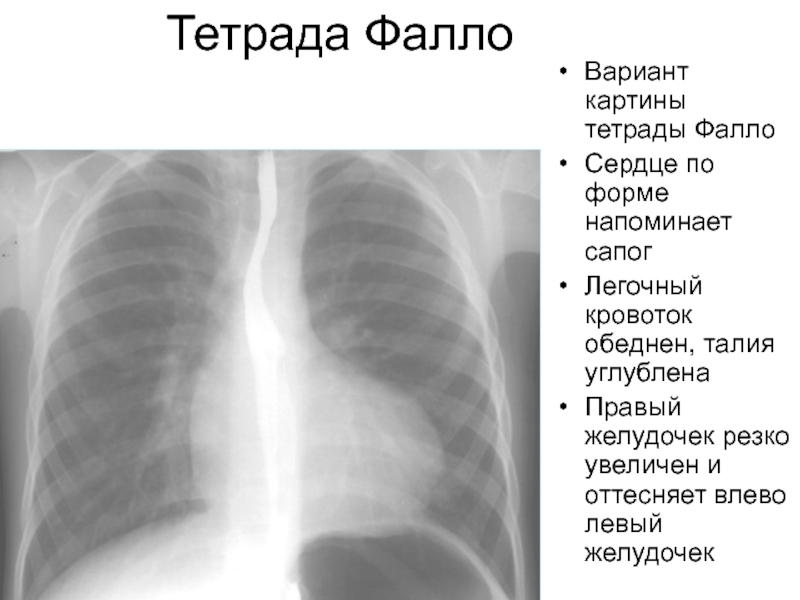 Тетрада фалло презентация педиатрия